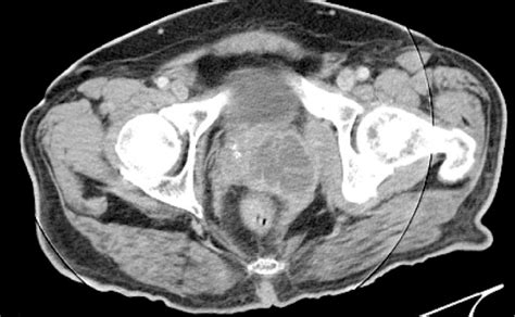 Figure 2 From A Case Of Perianal Abscess Due To Prostatic Abscess Semantic Scholar