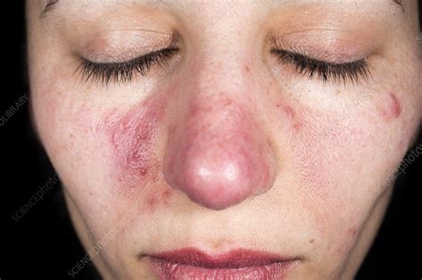Acne Rosacea Stock Image C0180325 Science Photo Library