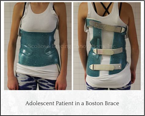 Scoliosis Brace Under Clothes