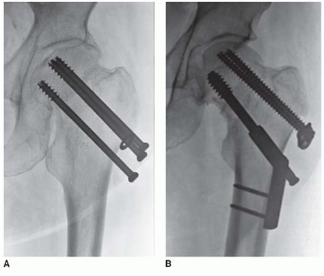 Femoral Neck Fractures Open Reduction Internal Fixation