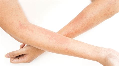 Understanding Atopic Dermatitis Health Choices First