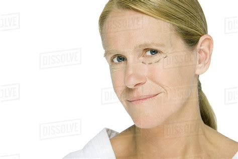 Woman With Plastic Surgery Markings Under One Eye Smiling At Camera