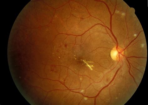 Clinically Significant Macular Edema Endotext