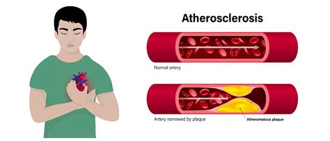 Atherosclerosis Vector Concept The Difference Of Normal Artery And
