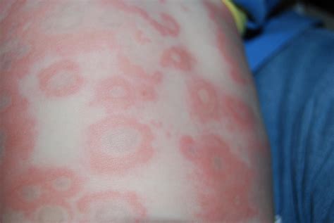 Erythema Multiforme And Psoriasis At University Of Florida College Of