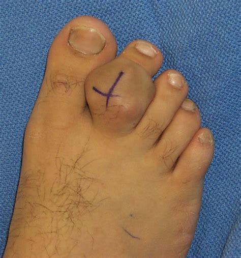 Giant Cell Tumor Of Tendon Sheath Foot And Ankle