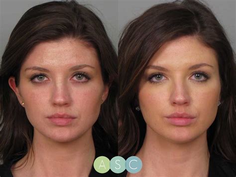 Botox Before After Photo Gallery Atlanta Roswell Ga
