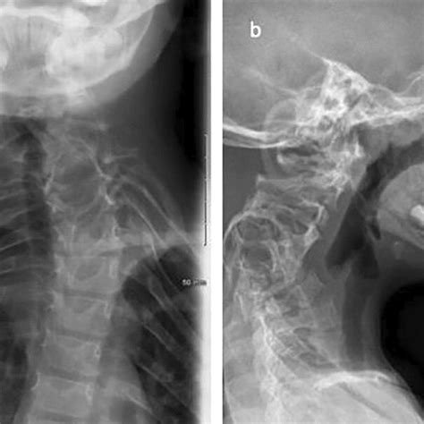 Case 1 Anteriorposterior A And Lateral B Radiographs Of The