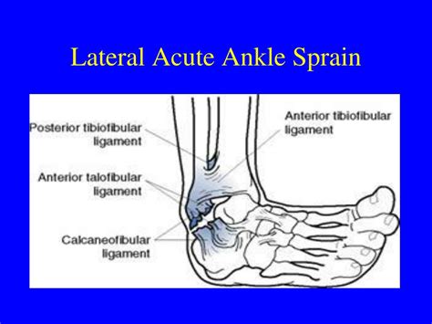 Ppt Ankle Sprains Powerpoint Presentation Free Download Id5492236