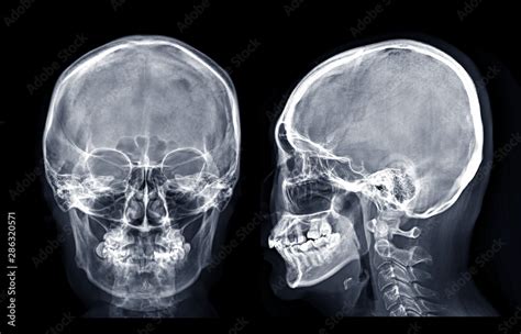 Skull X Ray Image Of Human Skull Ap And Lateral Isolated On Black
