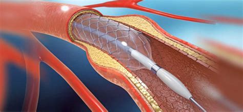 What Is A Cardiac Stent Everything You Need To Know Aakash Healthcare