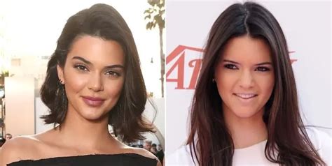 Kendall Jenner Surgical And Non Surgical Cosmetic Treatments Before