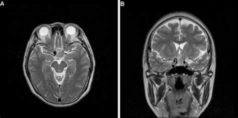 Axial A And Coronal B View Of T2 Weighted Mri Showi Open I
