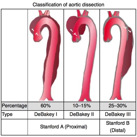 Acute Aortic Dissection Doctor Guidelines