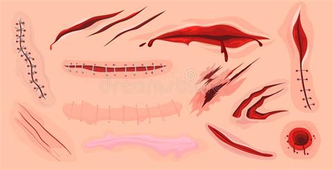 Skin Wounds Stock Illustration Illustration Of Hematoma 74056337