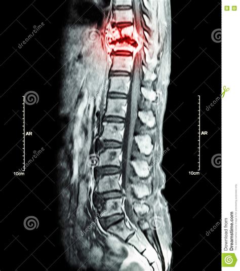 Metastasi Della Spina Dorsale (cancro Sparso Alla Spina ...