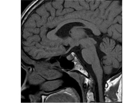 Pdf Pituitary Cyst In A Patient With Candle Syndrome And Delayed Puberty