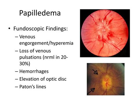 Ppt Stanford Medicine 25 Fundoscopy Powerpoint Presentation Free