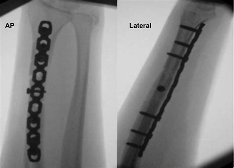 Cureus A Novel Method Of Treatment For A Mal United Galeazzi Fracture