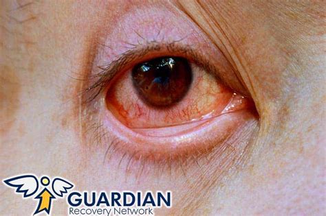 What Are Meth Eyes Meths Effects On Pupils And Eyes Guardian