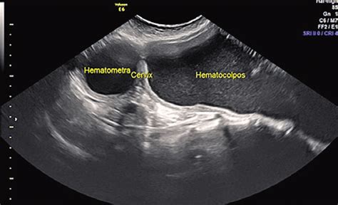 Ultrasound Scan Showing The Fluid In The Vagina Hematocolpos And