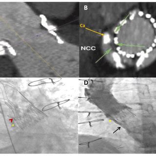 Multidetector Computed Tomography Angiography MDCTA Scans With