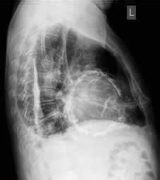 O pulso paradoxal pode ser um sinal de pericardite constritiva ou de tamponamento cardíaco (também encontrado em situações de hipertensão pulmonar grave). Pericardite