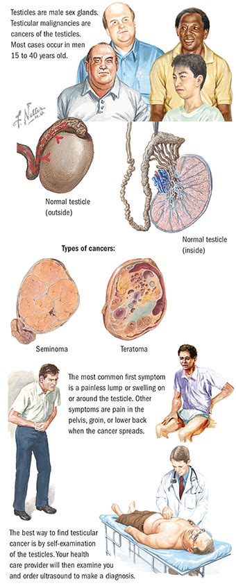 Testicular cancer is the most common type of cancer for american men between the ages of 15 and 34, according to the mayo clinic. Testicular Cancer | Spectrum Health