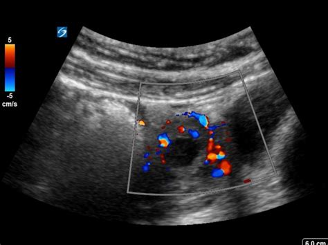 Unruptured Left Ectopic 7 Weeks Critical Care Sonography