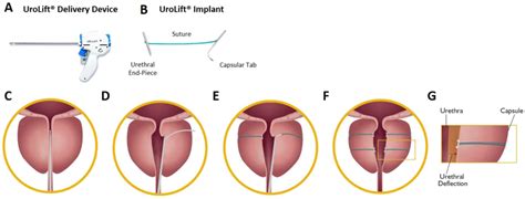 UroLift System Components And Procedure The UroLift System Is Comprised Download Scientific