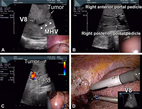 Intraoperative Ultrasonography Of Laparoscopic Hepatectomy Key
