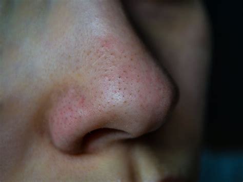 6 Scary Things That Could Happen If You Pick Your Blackheads