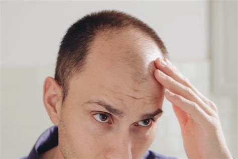 What Are The Causes Of A Bald Spot Bio Hair Clinic