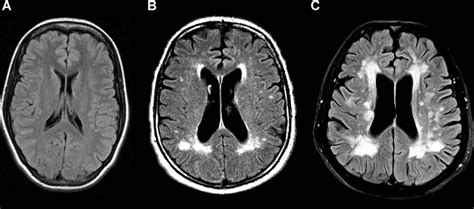 White Matter Lesion Severity In Mild Acute Ischemic Stroke Patients And