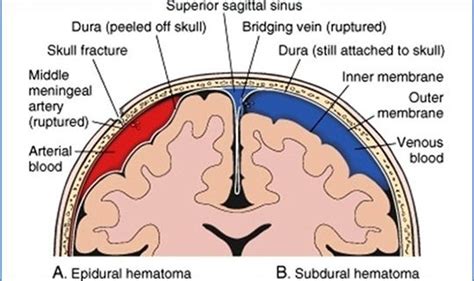 Epidural or extradural hematoma is a type of traumatic brain injury in which a buildup of blood occurs between the an epidural hematoma is a collection of blood between the dura and. Epidural Hematoma | Epidural Hematoma Clinical Presentation