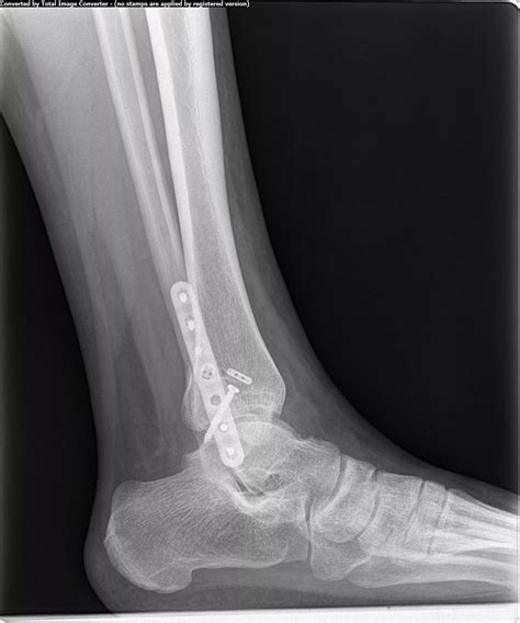 Ankle Fracture Types
