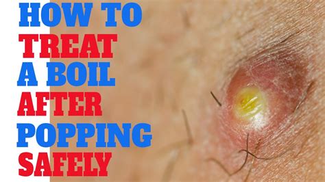 What To Do When A Boil Pops How Do You Treat A Boil How To Drain
