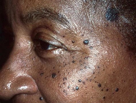 Irregular Moles Archives The Pretty Pimple