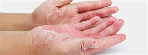 Hand Washing And Hand Dermatitis