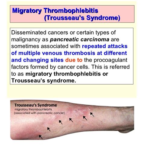 Migratory Thrombophlebitis Trousseau Syndrome Also Trosier