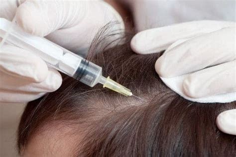 It's caused by your immune. Mesotherapy for Hair Loss Treatment - Majestic Derma