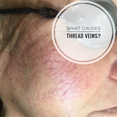What Causes Thread Veins On The Face Find Out Here