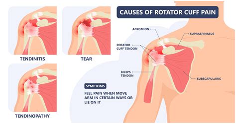 Rotator Cuff Injury Treatment Options Advanced Surgery Center