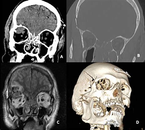 Preoperative Coronal Ct Scan With Brain A And Bone B Windows