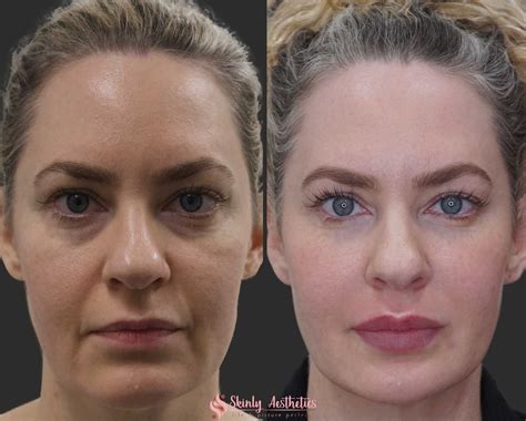 The Complete Guide To Under Eye Fillers At Skinly Aesthetics