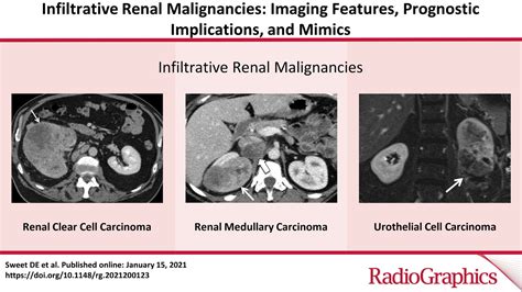 Infiltrative Renal Malignancies Imaging Features Prognostic
