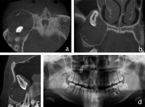 Case 4 With Dissimilar Radiographic Features On Cbct And Panoramic