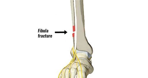 Fibula Fractures Types Symptoms Causes And Treatment Zealmax Innovations Pvt Ltd