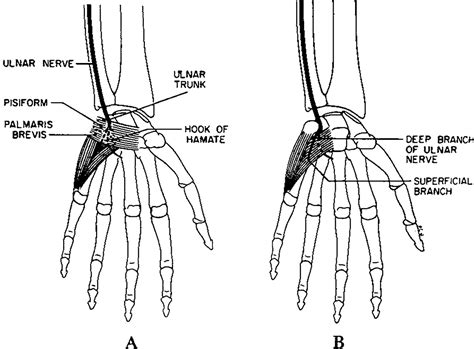 Peripheral Entrapment Neuropathies Of The Upper Extremity Nejm