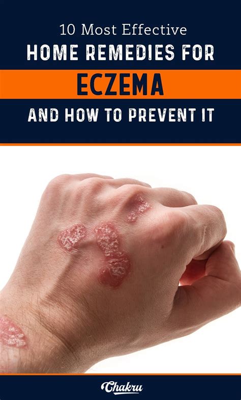 Best Home Remedies For Eczema And How To Prevent It Completely Home